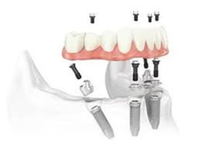 Animation of implant supported dentures