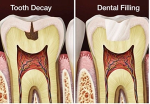 Before and After of dental decay being treating with a filling