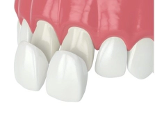 Animation displaying porcelain veneers