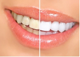 Before and after of teeth whitening