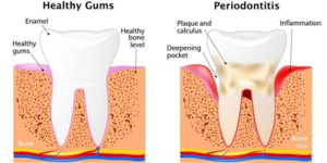 An animated healthy and unhealthy gums